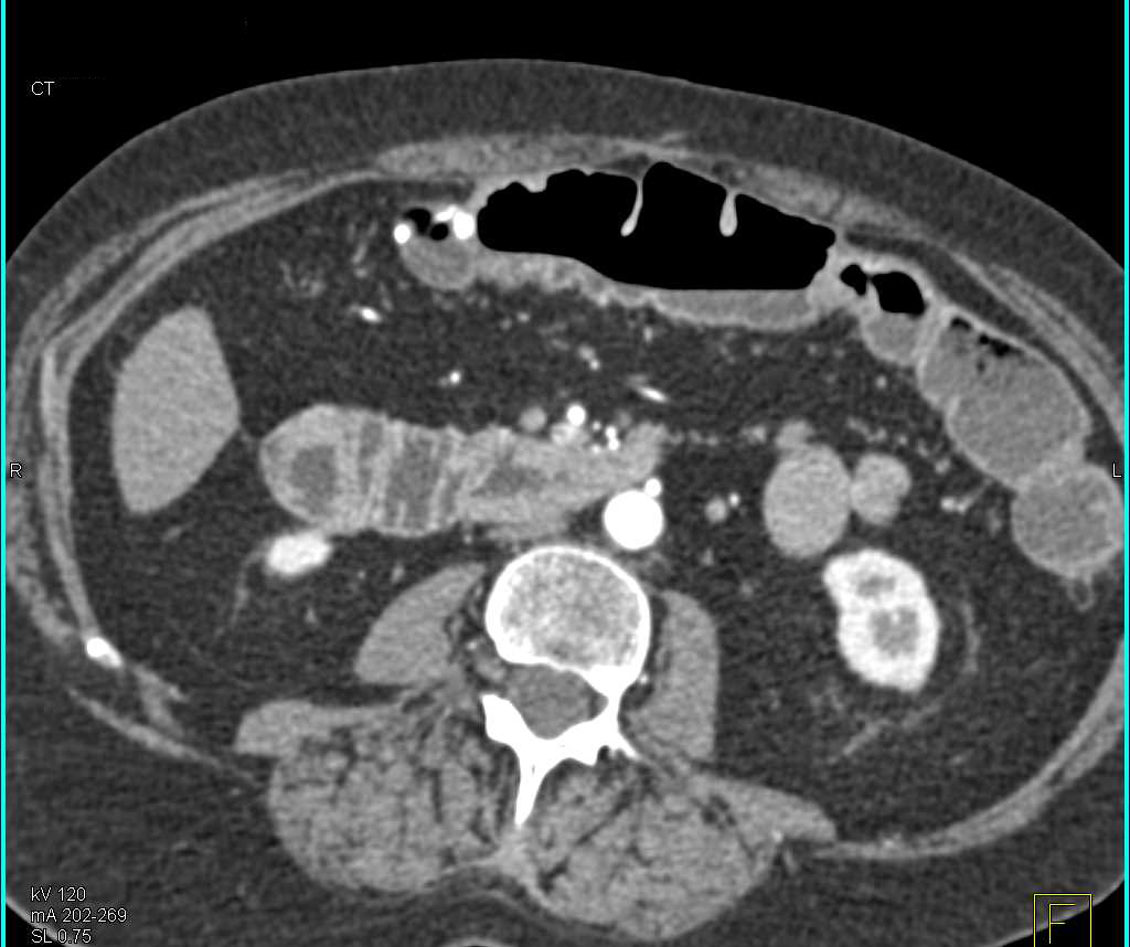 Crohn's Colitis Colon Including the Rectum with CTA - CTisus CT Scan