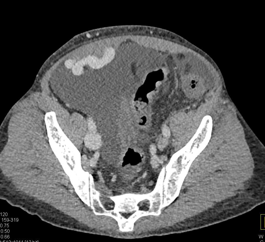 Perirectal Varices due to Portal Hypertension - CTisus CT Scan