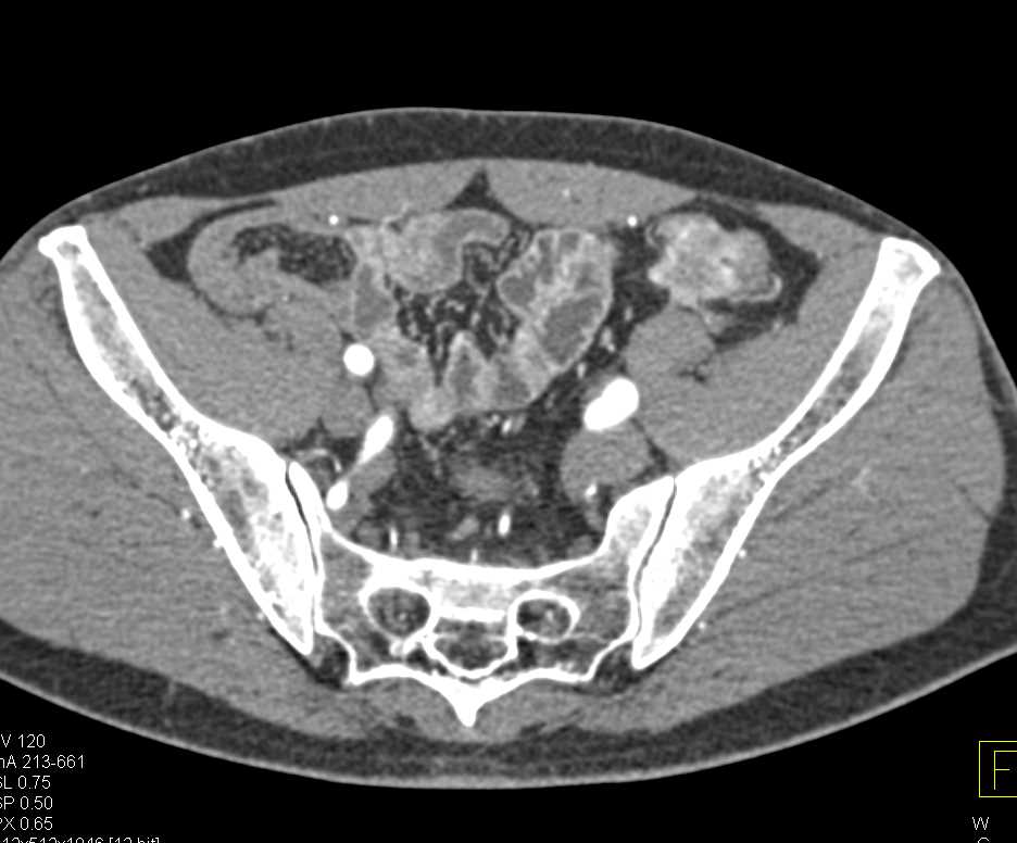 Neuroendocrine Tumor Descending Colon - CTisus CT Scan