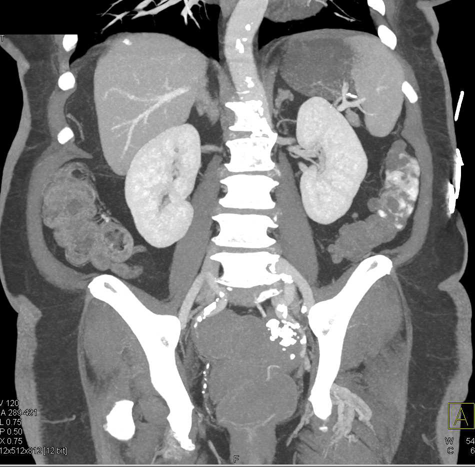 Active Bleed Left Colon due to Diverticulitis Best Seen on Venous Phase - CTisus CT Scan