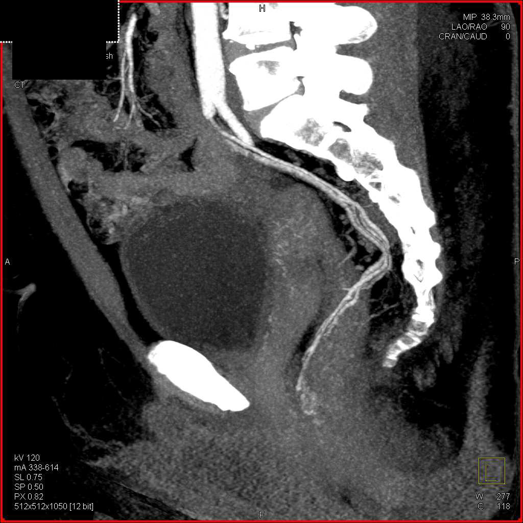 Rectal Thickening with Prominent Vascularity - CTisus CT Scan