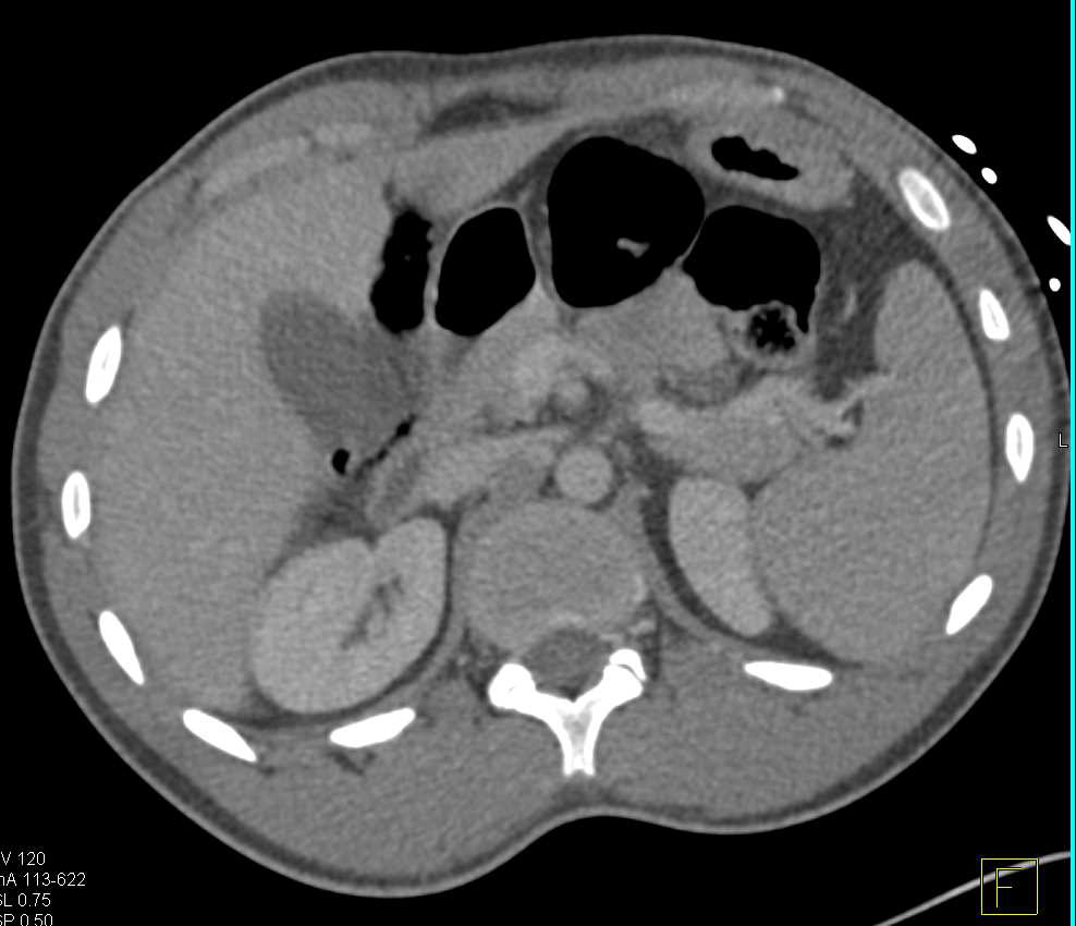 Rectal Contrast in Patient with Stab Wound Near Cecum and Subtle Contrast Extravasation due to Colon Injury - CTisus CT Scan