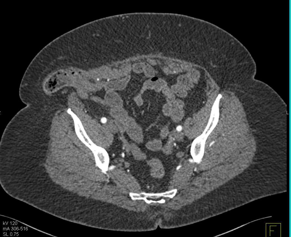 Hernia in Defect in Right Lower Quadrant - CTisus CT Scan