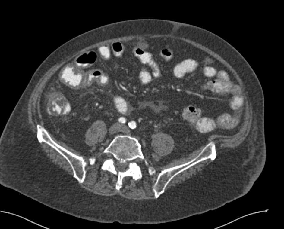 Adenocarcinoma of the Cecum with Local Inflammation - CTisus CT Scan