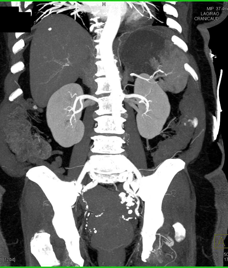 CTA with Active Bleeding Left Colon due to Bleeding Diverticulum and Better Seen on Venous Phase Images - CTisus CT Scan