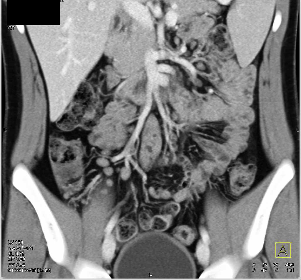 Crohn's Disease Involves the Ileum and Cecum with Mesenteric Adenopathy - CTisus CT Scan