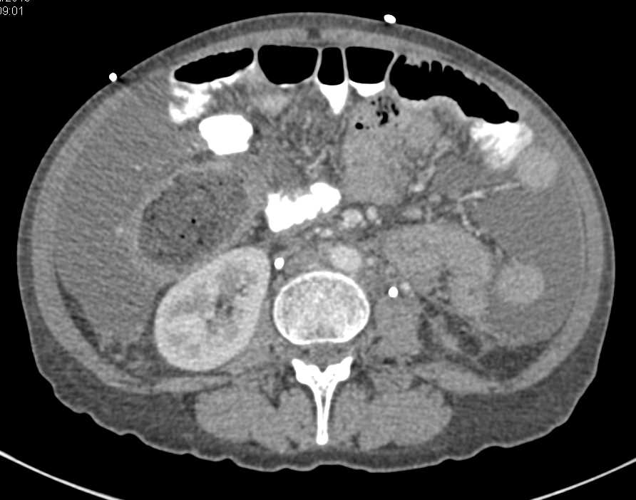 Colitis with Involvement of Terminal Ileum Plus Extensive Ascites - CTisus CT Scan