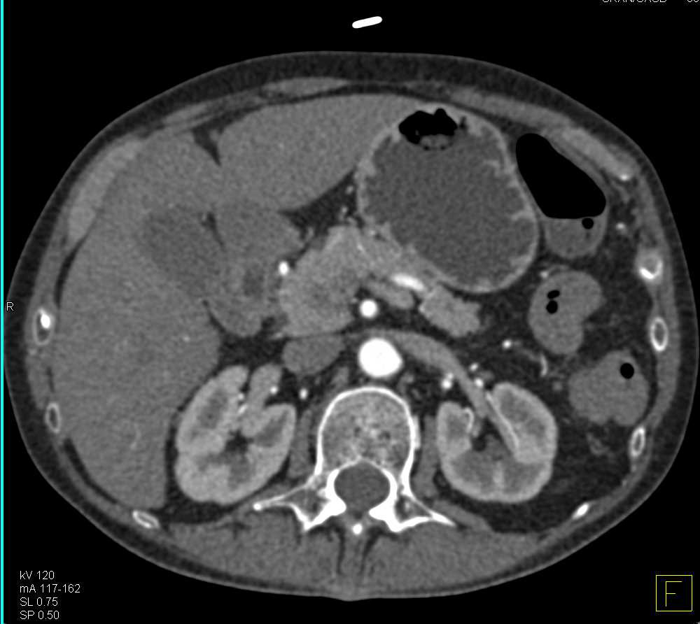 Ulcerative Colitis with Stricture Best Seen in Rectum - CTisus CT Scan