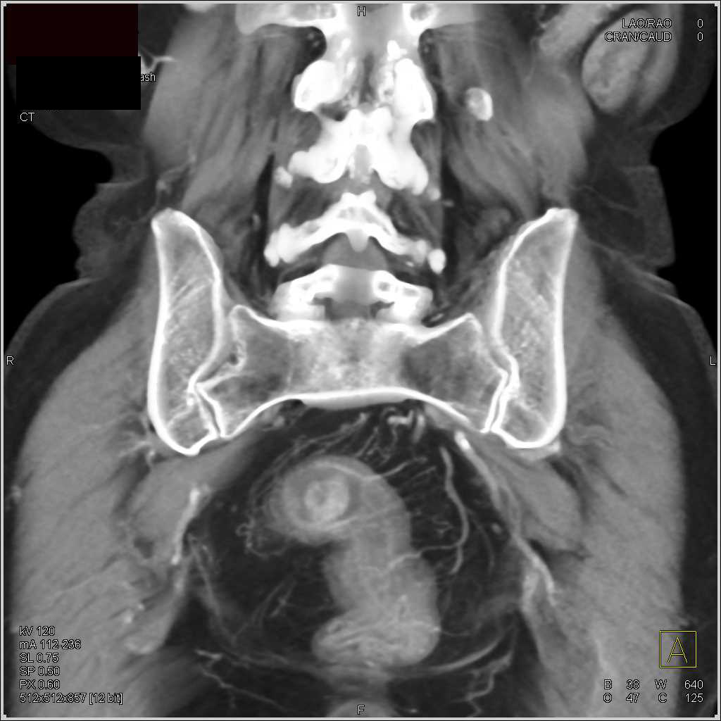 Ulcerative Colitis with Stricture Best Seen in Rectum - CTisus CT Scan