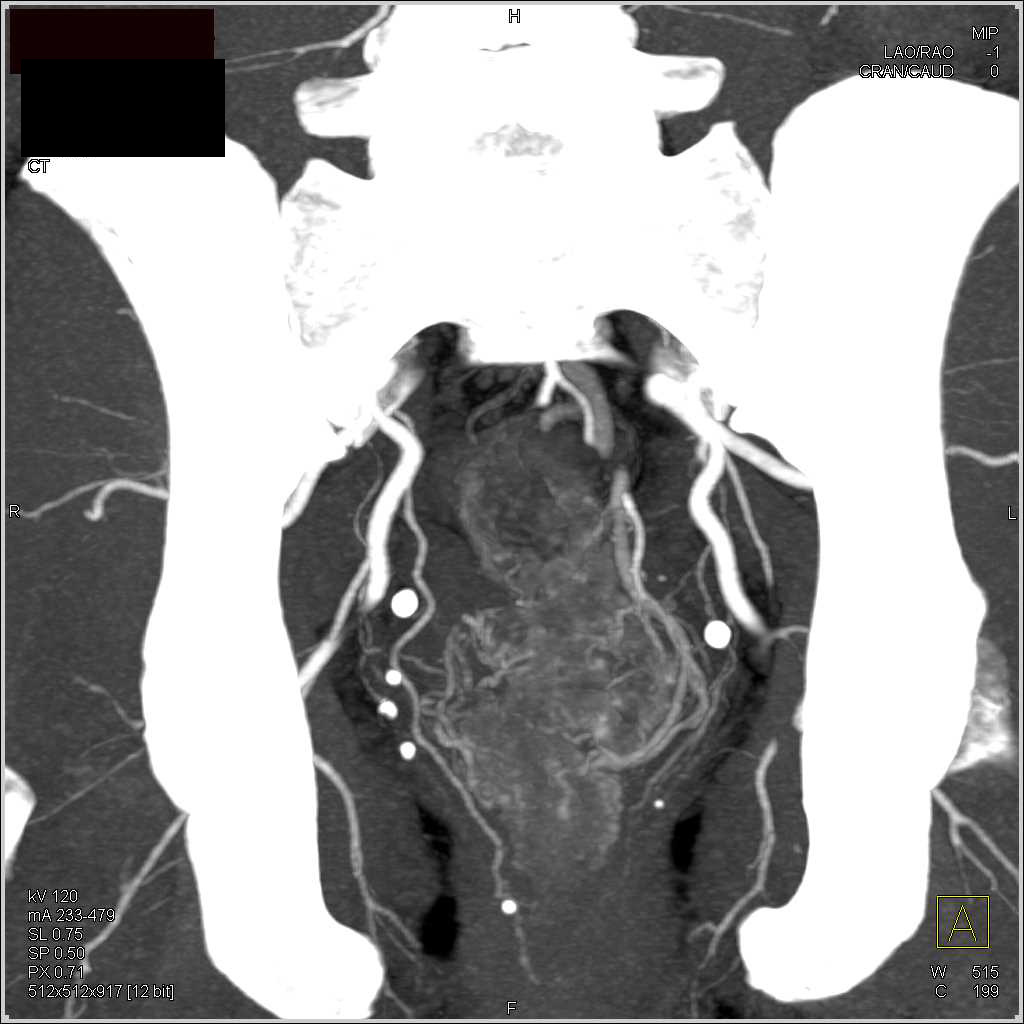 Thickened Rectum with Increased Vascularity Consistent with Colitis - CTisus CT Scan