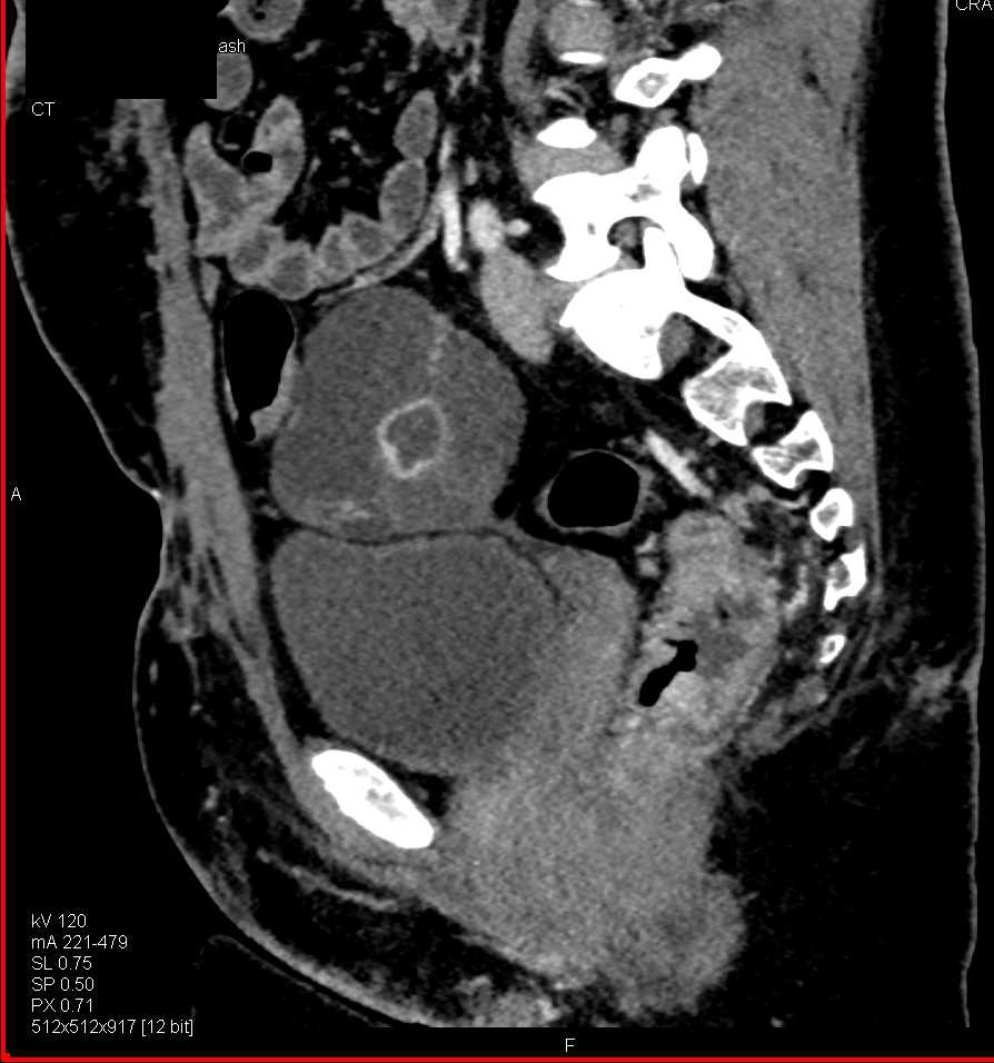 Thickened Rectum with Increased Vascularity Consistent with Colitis with CTA Demonstrating Vascularity - CTisus CT Scan