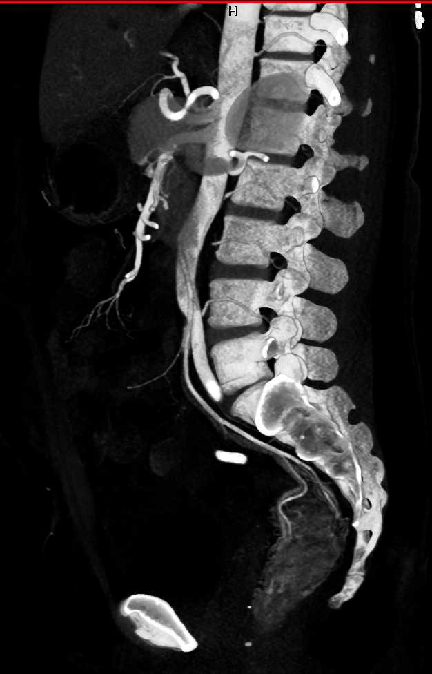 Thickened Rectum with Increased Vascularity Consistent with Colitis with CTA Demonstrating Vascularity - CTisus CT Scan