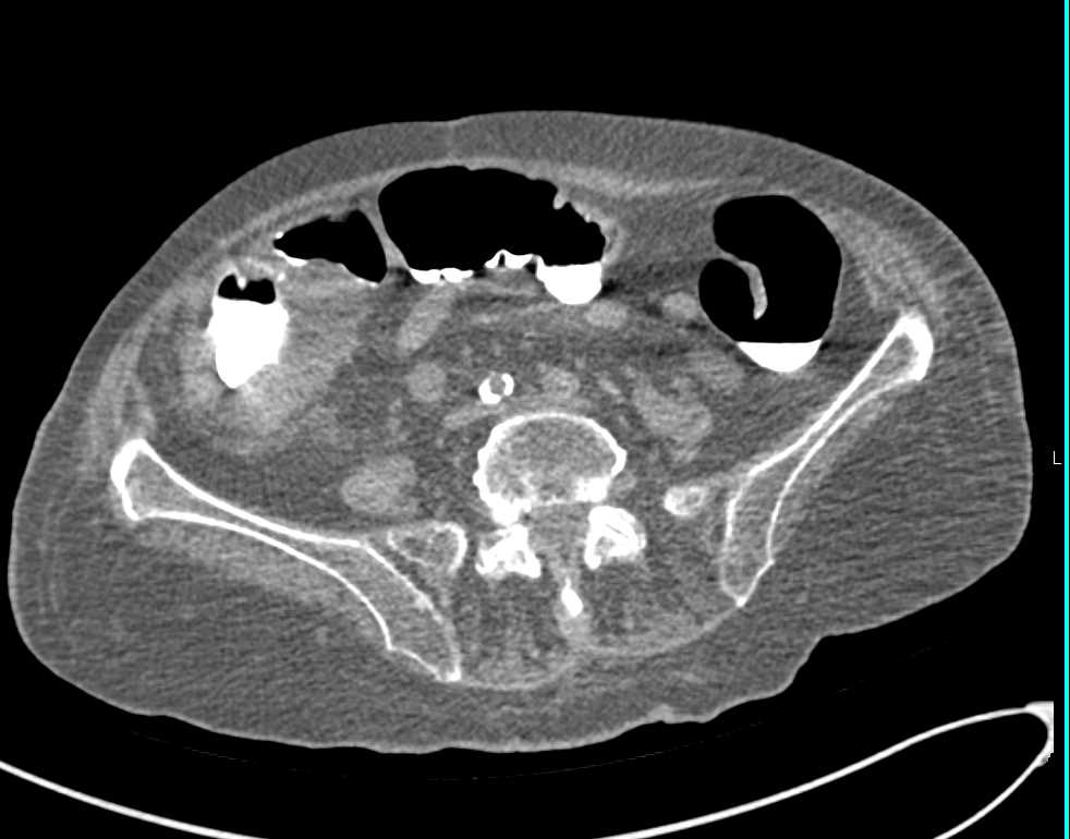 Cecal Carcinoma - CTisus CT Scan