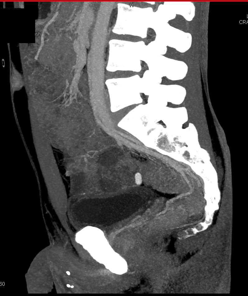 Gastrointestinal (GI) Bleed Due to Proctitis - CTisus CT Scan