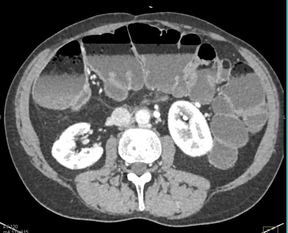 Patient Takes Laxatives as Shown by Fat Fluid Levels in Colon - CTisus CT Scan