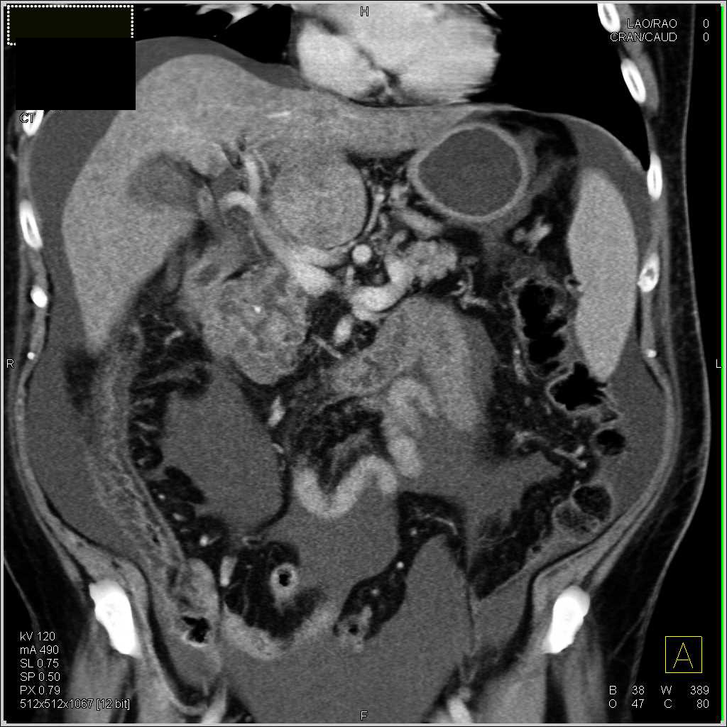 Ascites and Colitis - CTisus CT Scan