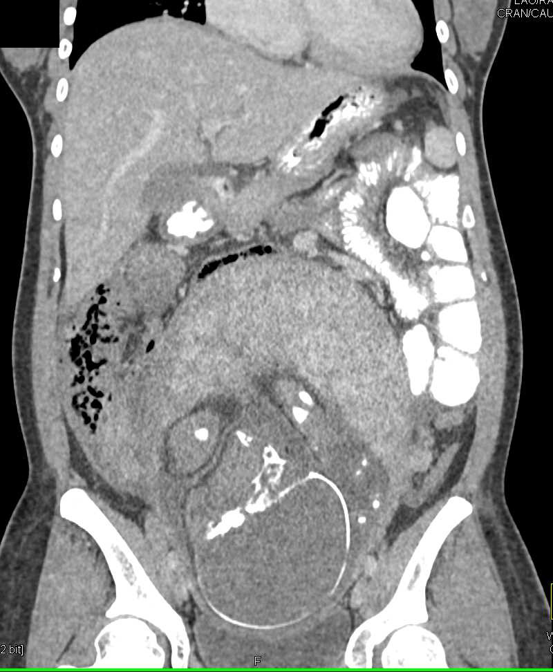 Appendicitis in a Pregnant Patient - CTisus CT Scan