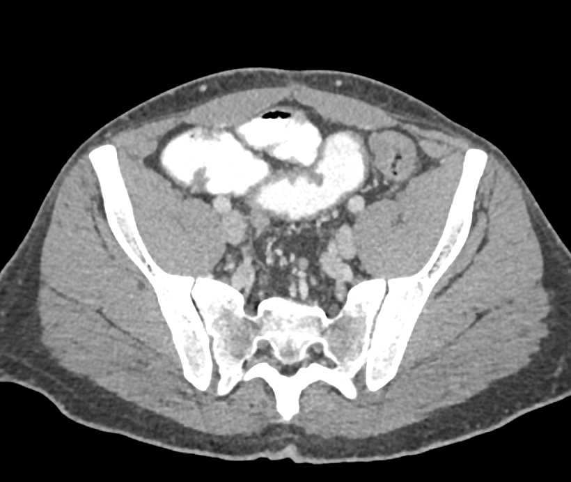 Ulcerative Colitis Involving Rectum - CTisus CT Scan