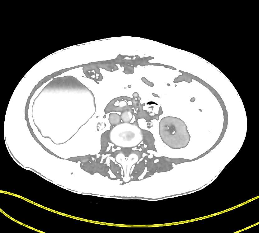 Crohn's Disease with Right Lower Quadrant Abscess - CTisus CT Scan