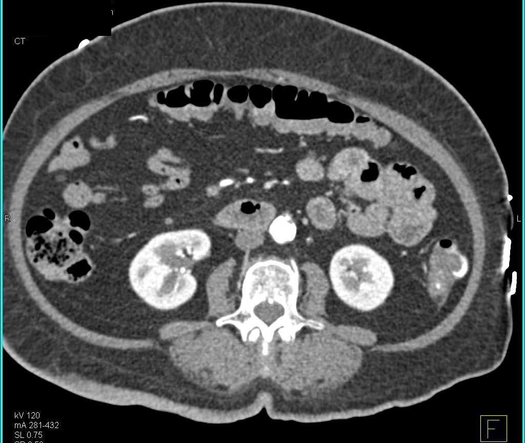 Active Bleed Descending Colon due to Diverticulitis - CTisus CT Scan