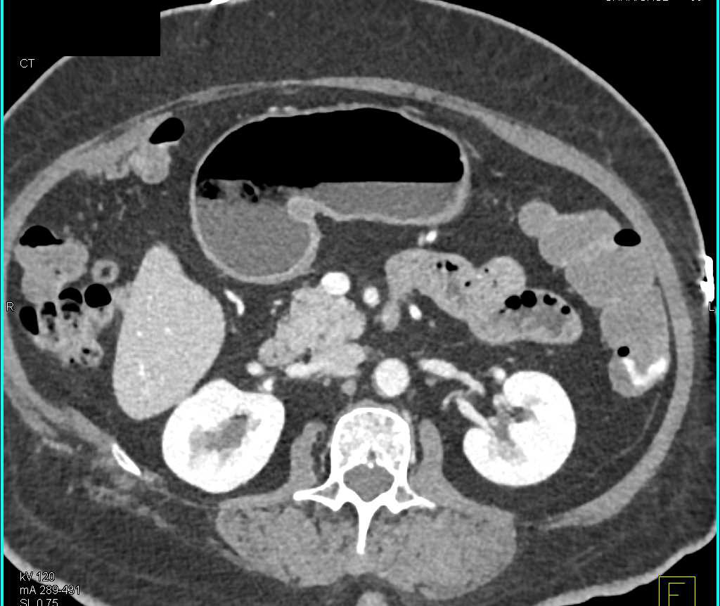 Active Bleed Descending Colon due to Diverticulitis - CTisus CT Scan