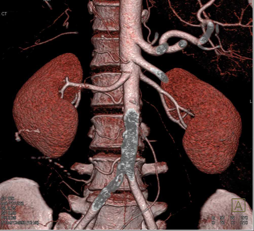 Sigmoid Volvulus - CTisus CT Scan