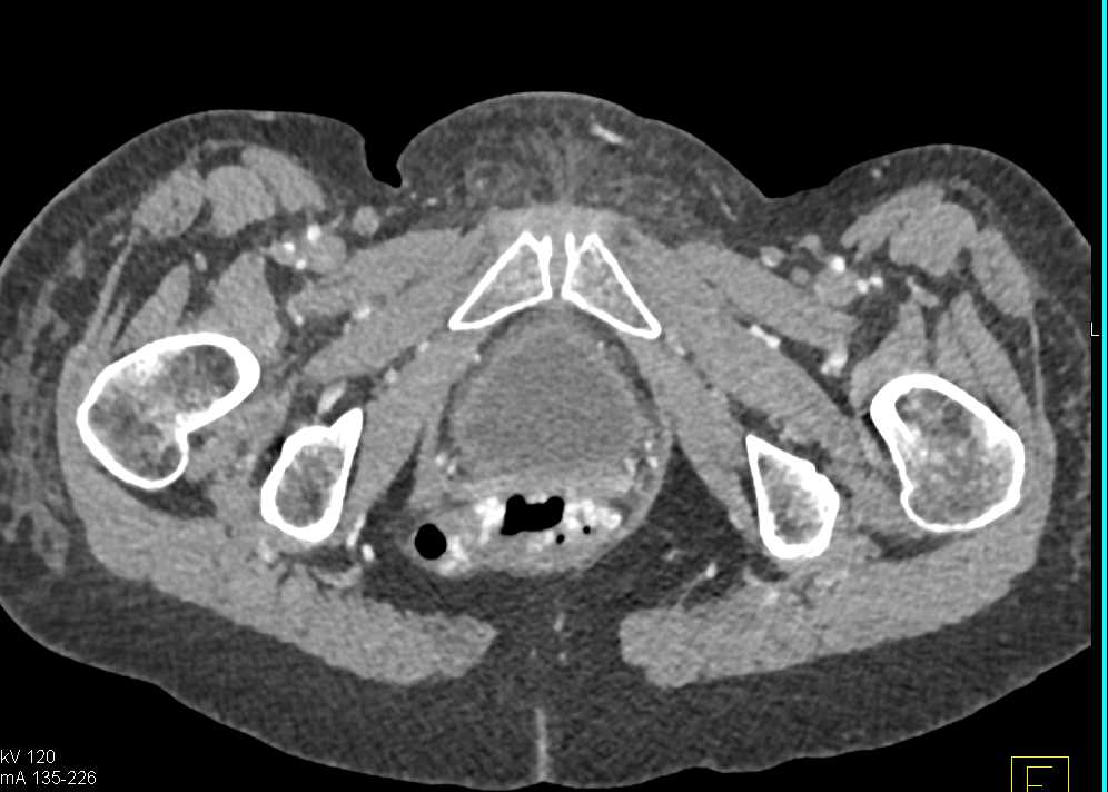 Gastrointestinal (GI) Bleed due to Rectal Varices in a Patient with Portal Hypertension - CTisus CT Scan