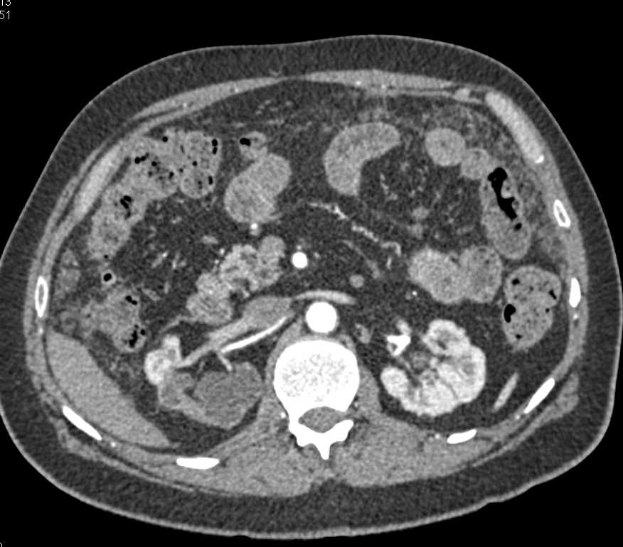 Inflamed Left Colon and Incidental Dilated Calyces Right Kidney - CTisus CT Scan