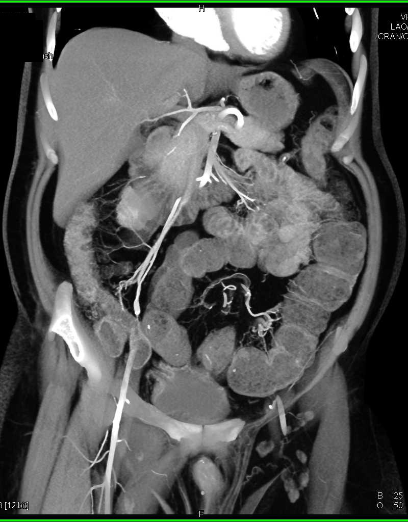 Colitis Colon - CTisus CT Scan