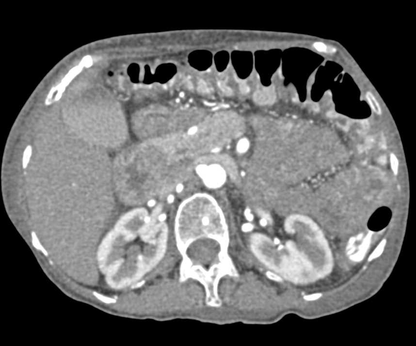 Colitis Involving the Right Colon with CT Angiography - CTisus CT Scan