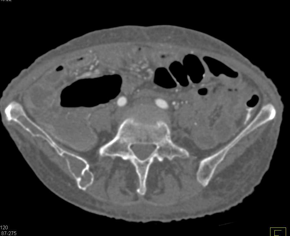 Colitis Right Colon - CTisus CT Scan