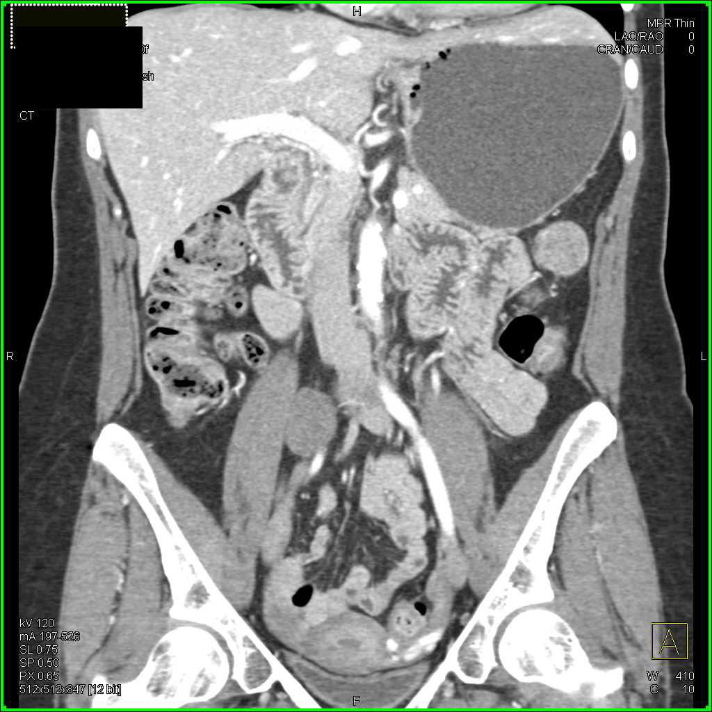 Cecal Carcinoma - CTisus CT Scan