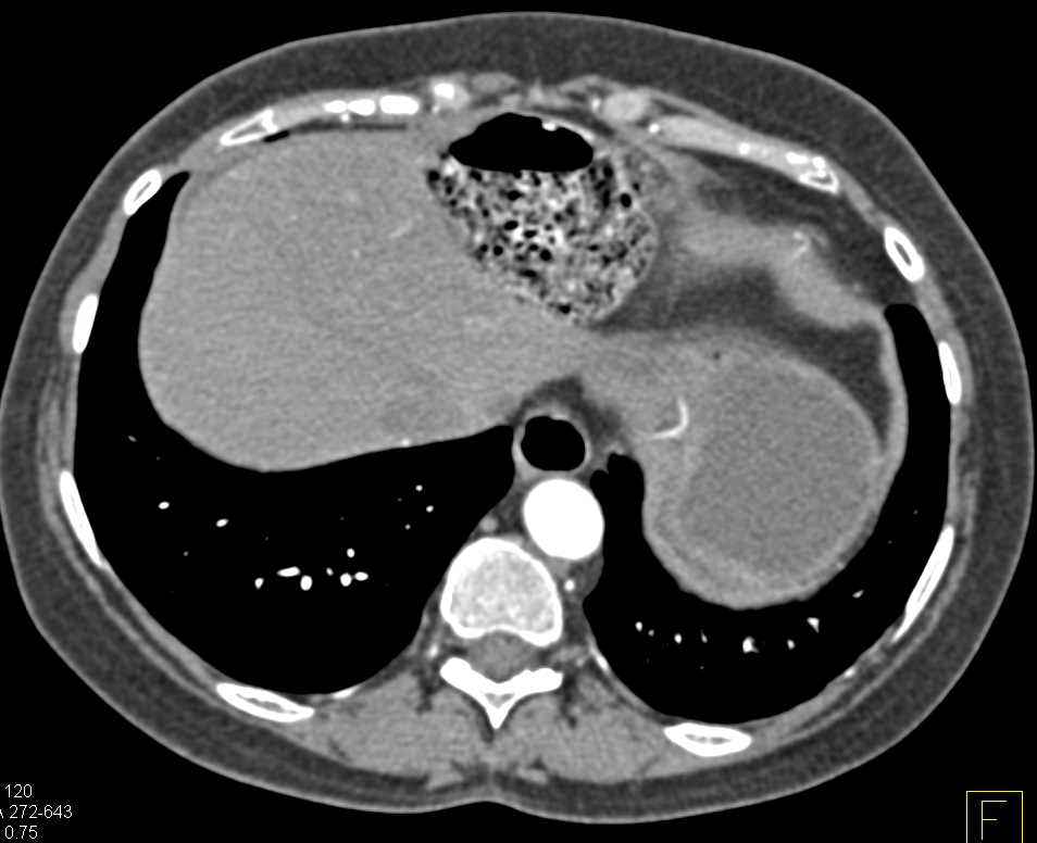 Small Bowel Obstruction (SBO) due to Cecal Volvulus - CTisus CT Scan