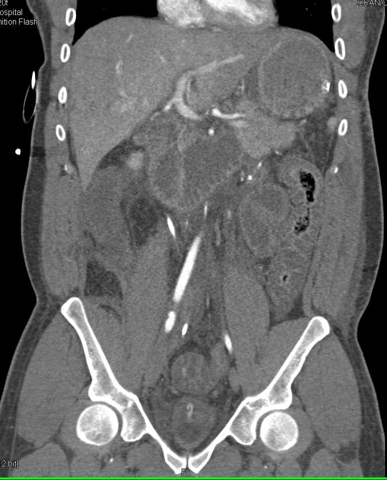 Pseudomembranous Colitis - CTisus CT Scan