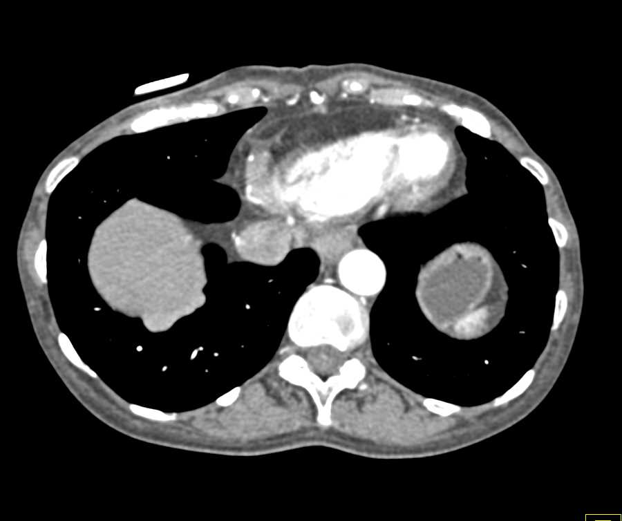 Pleural Implants from a GI Primary (Colon) - CTisus CT Scan