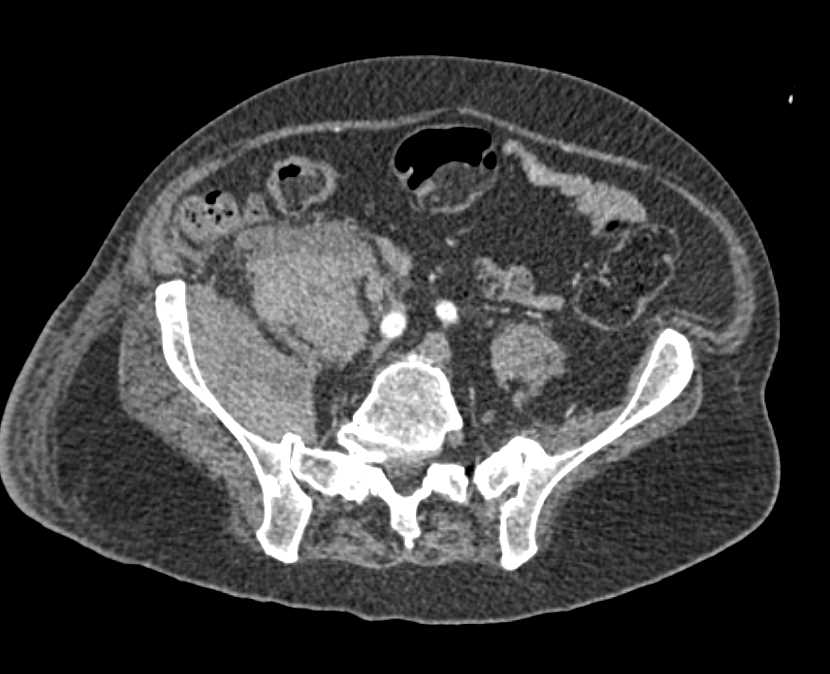 Right Lower Quadrant Bleed - CTisus CT Scan