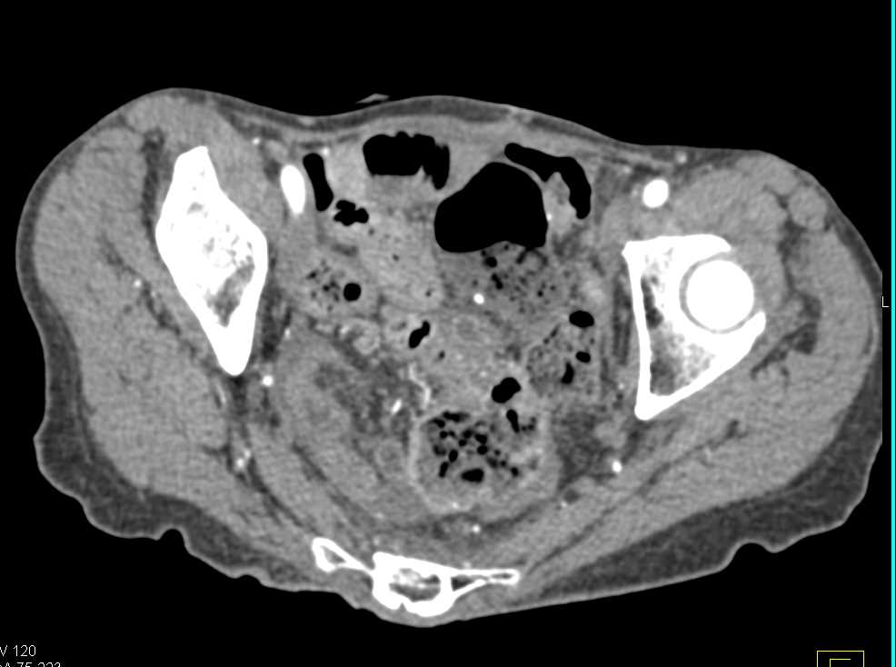 Rectal and Small Bowel Prolapse in the Pelvis - CTisus CT Scan