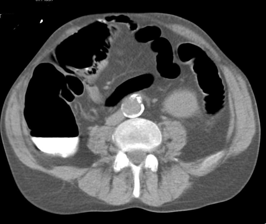 Pneumatosis in the Cecum - CTisus CT Scan