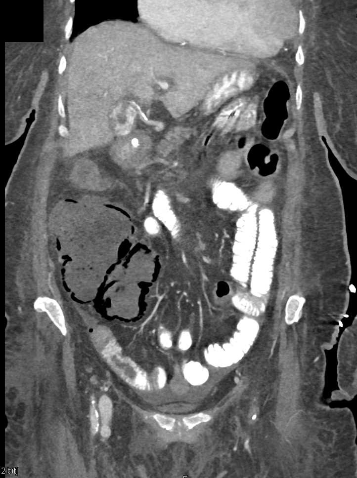 Ischemic Bowel with Peritonitis and Pneumoperitoneum and Pneumatosis - CTisus CT Scan