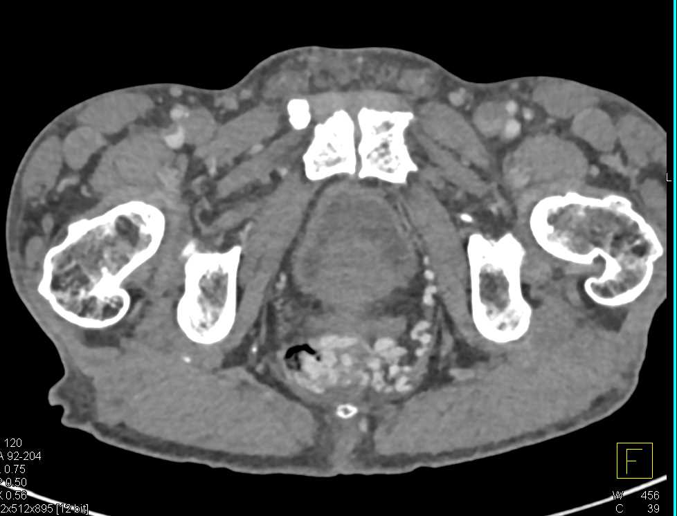 Gastrointestinal (GI) Bleed due to Rectal Varices - CTisus CT Scan