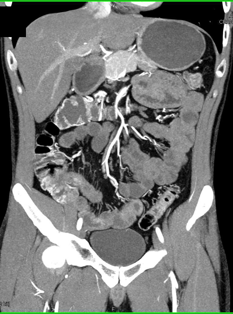 Ulcerative Colitis - CTisus CT Scan