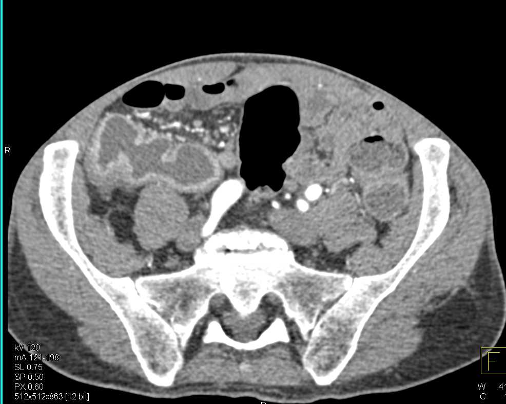 Ulcerative Colitis Involves Cecum and Ascending Colon as well as Sigmoid Colon - CTisus CT Scan