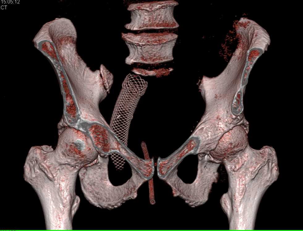 Bulky Rectal Cancer with Stent in Place as Well as Rectal Vesicle Fistulae - CTisus CT Scan