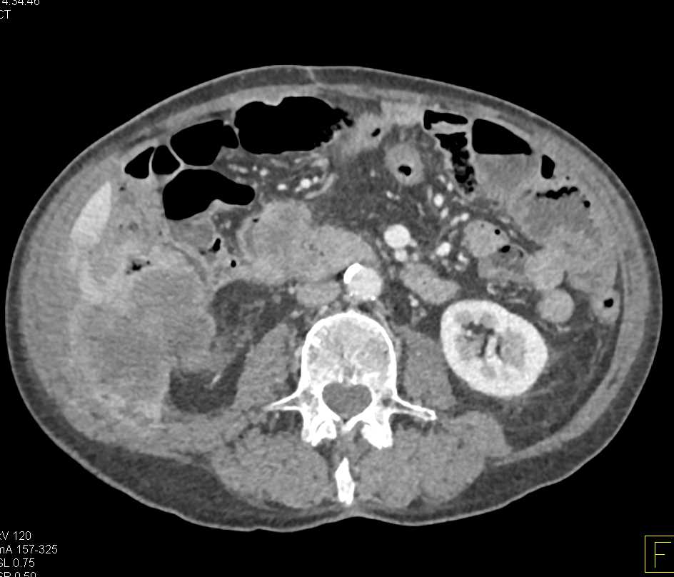 Cecal Cancer with Carcinomatosis - CTisus CT Scan