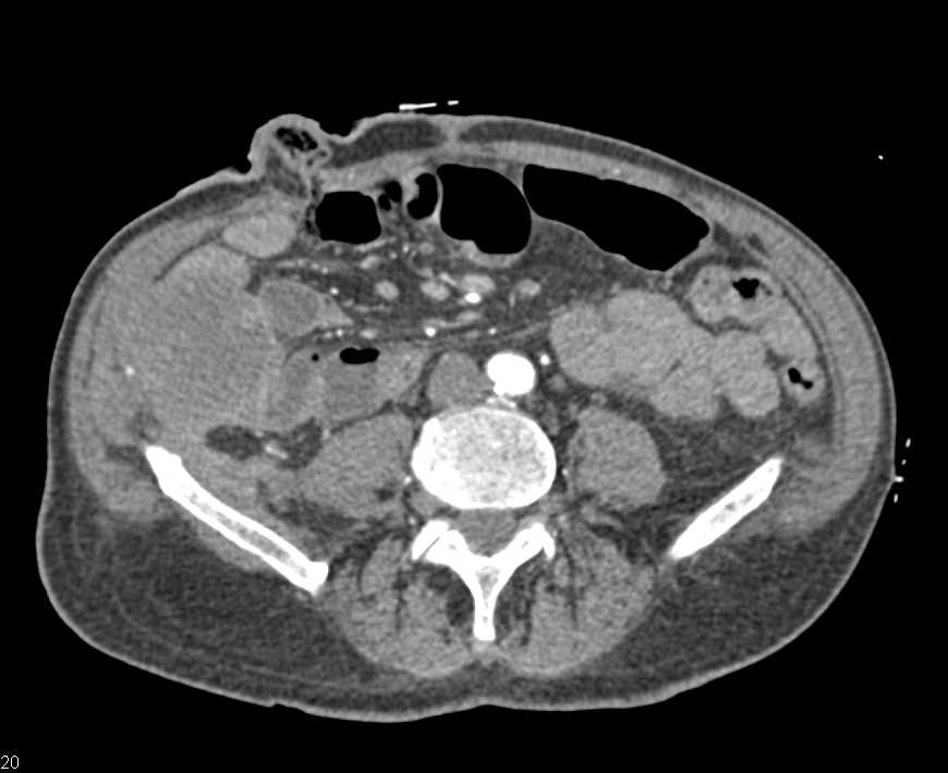 Cecal Carcinoma with Local Spread and Liver Metastases - CTisus CT Scan