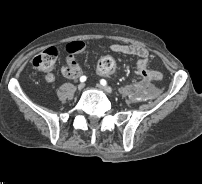 Diverticulitis with Left Lower Quadrant Abscess - CTisus CT Scan