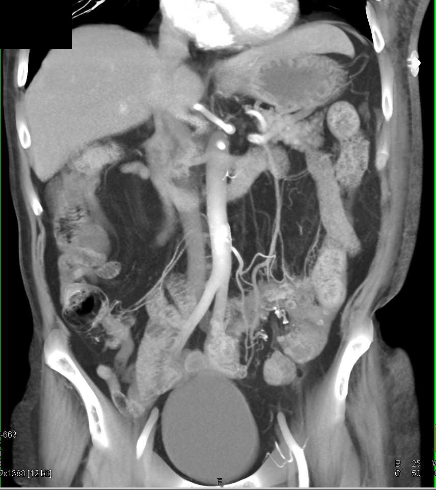 Diverticulitis with Left Lower Quadrant Abscess - CTisus CT Scan