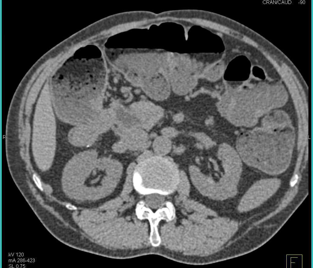 Malabsorption with Fat-Fluid Level in the Large Bowel - CTisus CT Scan