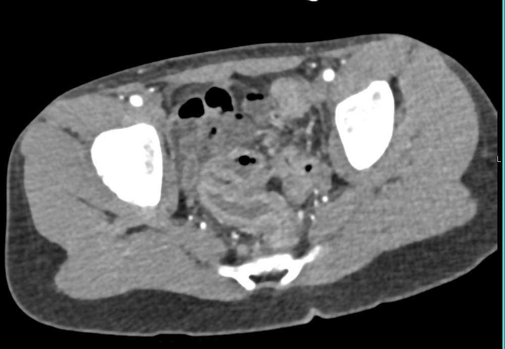 Ulcerative Colitis Involves Rectum - CTisus CT Scan