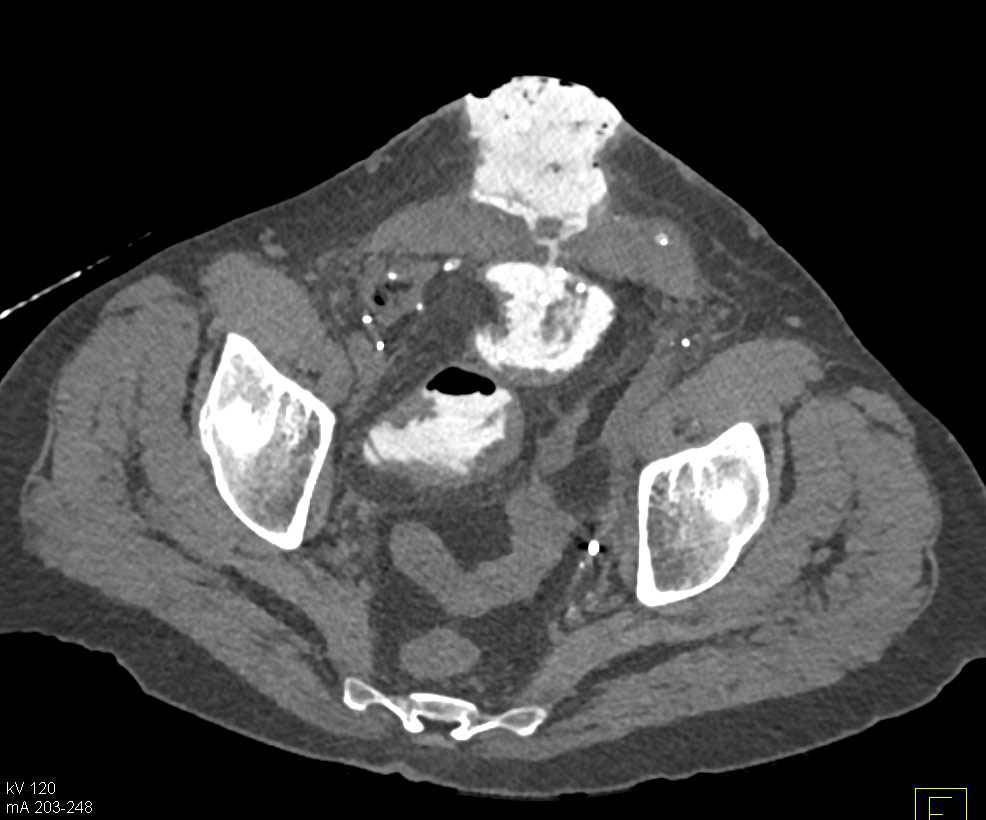 Fistulae from Colon to Abdominal Wall - CTisus CT Scan